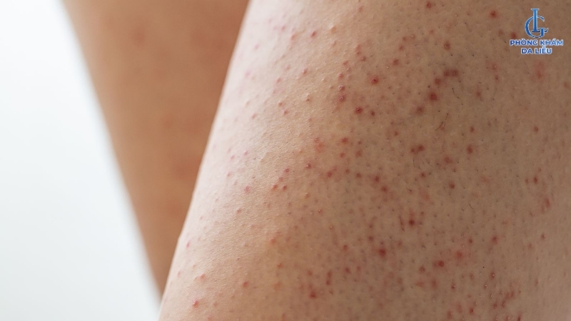 wax lông có làm to lỗ chân lông không