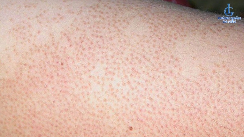 Viêm nang lông sau wax