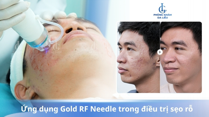 Điều trị sẹo rỗ
