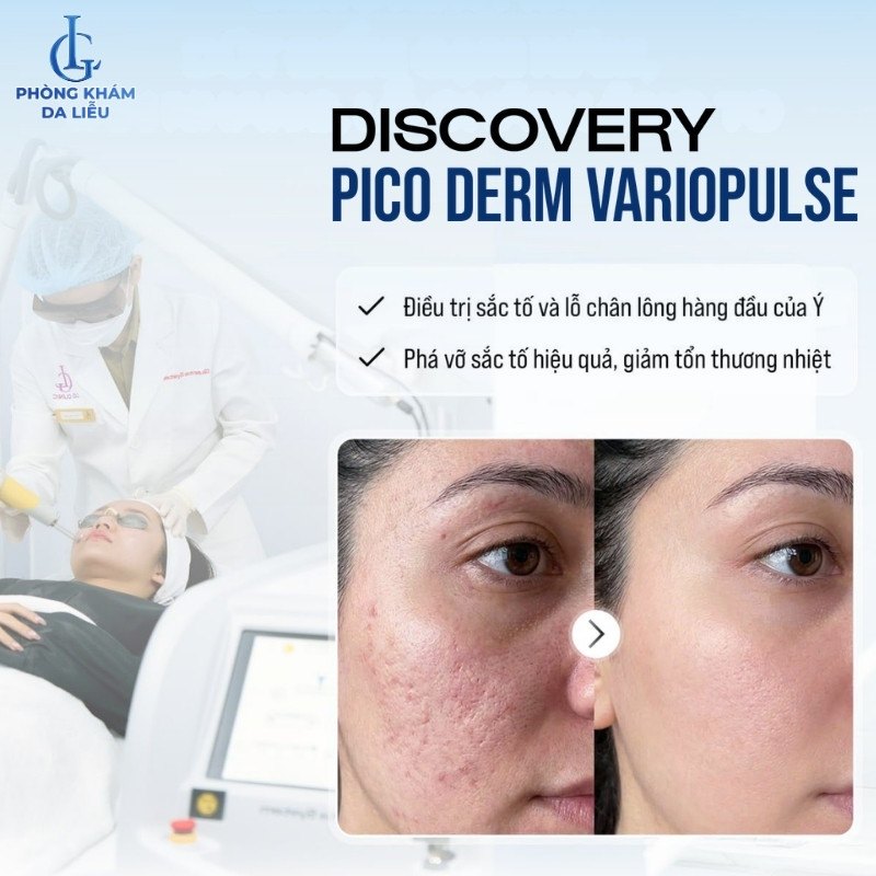 Discovery Pico Derm VarioPulse trị nám
