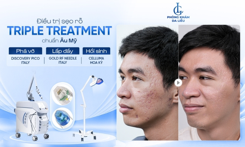 Discovery Pico Derm VarioPulse trị sẹo rỗ