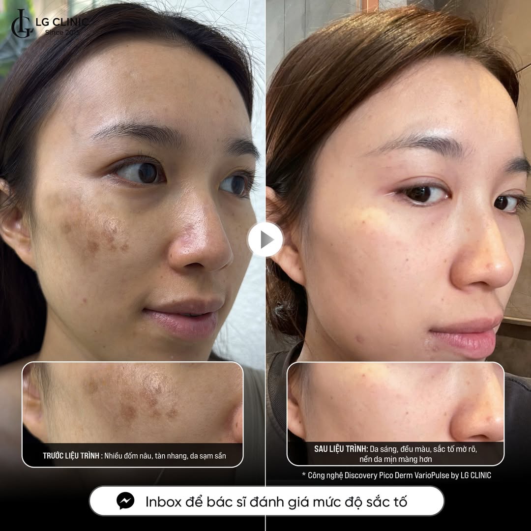 điều trị nám tại phòng khám da liễu lg