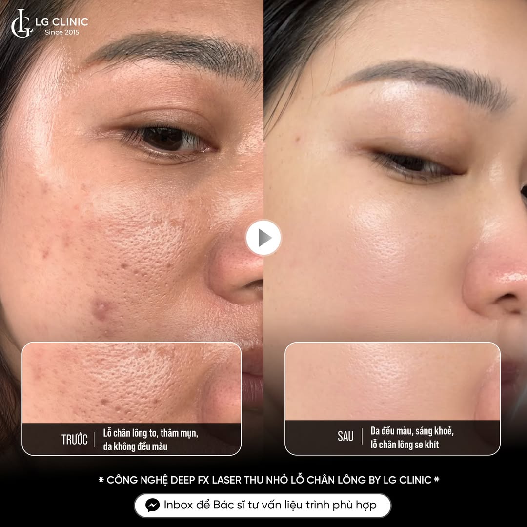 thu nhỏ lỗ chân lông tại phòng khám da liễu lg
