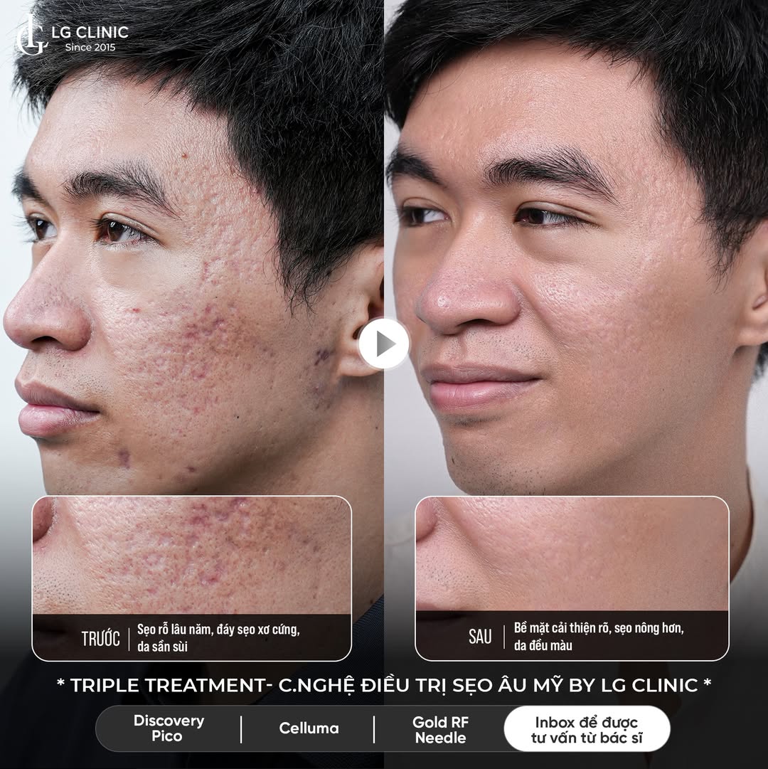 trị sẹo rỗ tại phòng khám da liễu lg