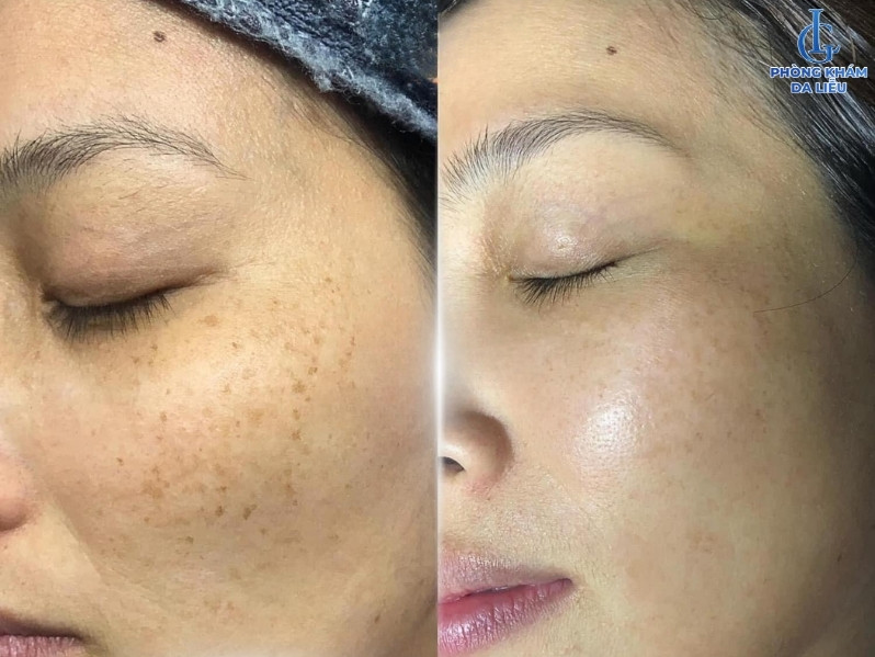 Hiệu quá xoá tàn nhang bằng laser