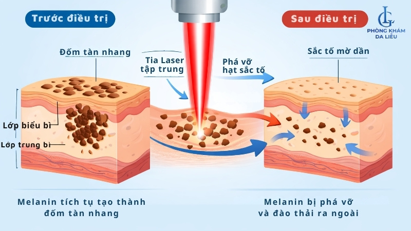Cơ chế trị tàn nhang bằng laser