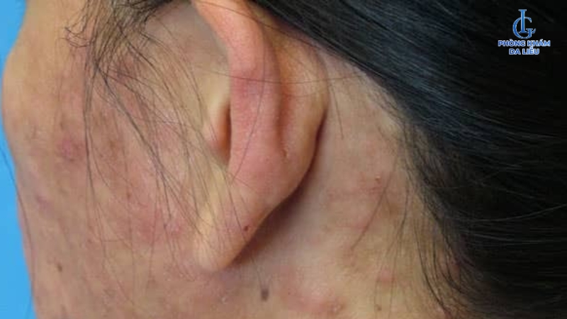 Hình ảnh viêm nang lông bạch cầu ái toan