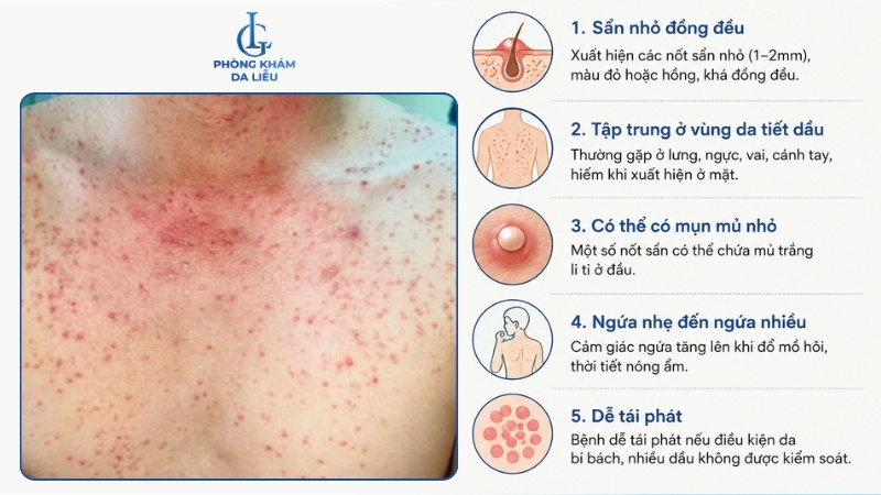 nấm Malassezia gây viêm nang lông