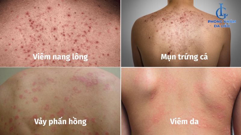 nguyên nhân nổi mẩn đỏ ở lưng không ngứa