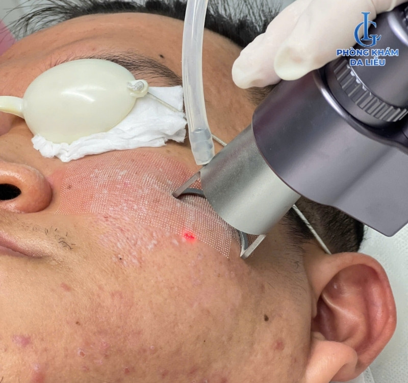 Laser trị sẹo lõm
