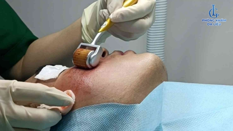 Lăn kim trị sẹo lõm