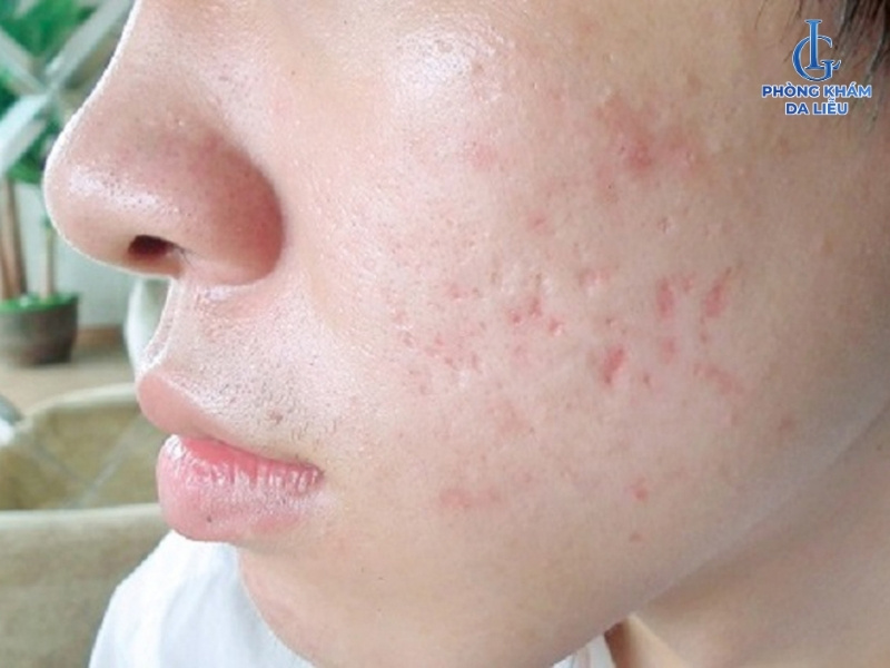 Hình ảnh sẹo lõm do mụn