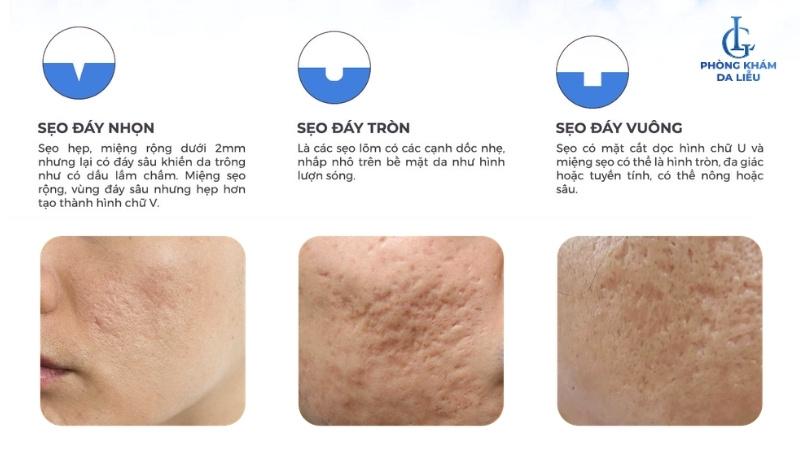 Phân loại sẹo lõm