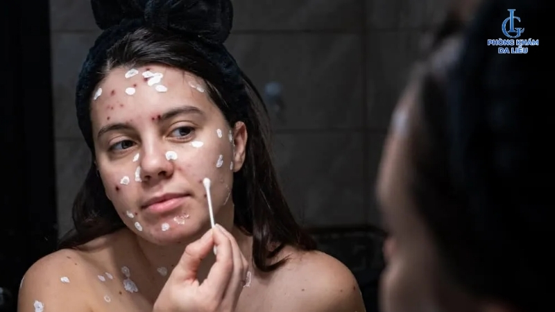 Bôi kem trị sẹo lõm