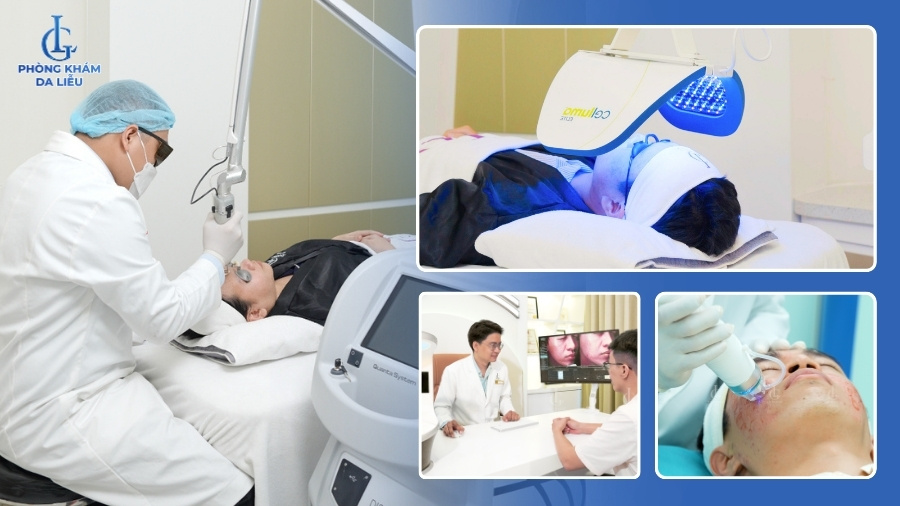 Cách trị sẹo lõm do mụn chuẩn y khoa