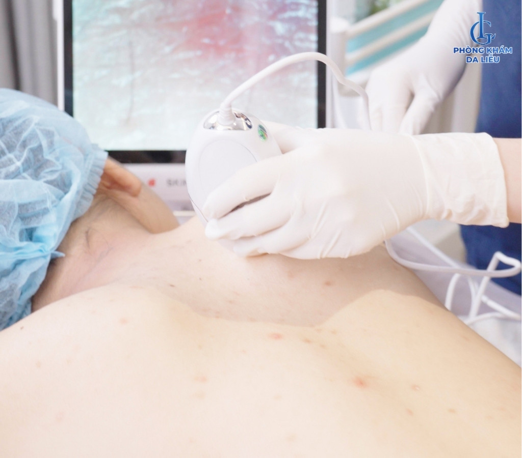 thăm khám viêm nang lông do nấm Malassezia