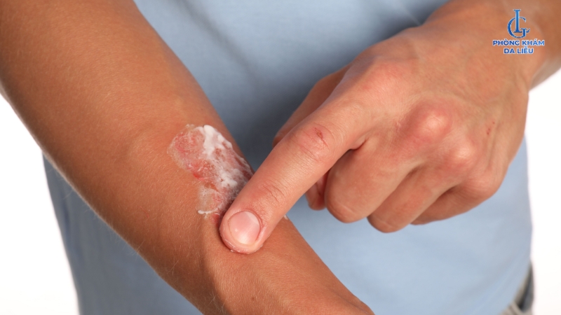 thuốc trị viêm nang lông bạch cầu ái toan