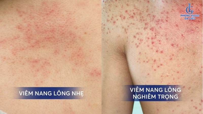 tình trạng viêm nang lông sau sinh nhẹ và nặng