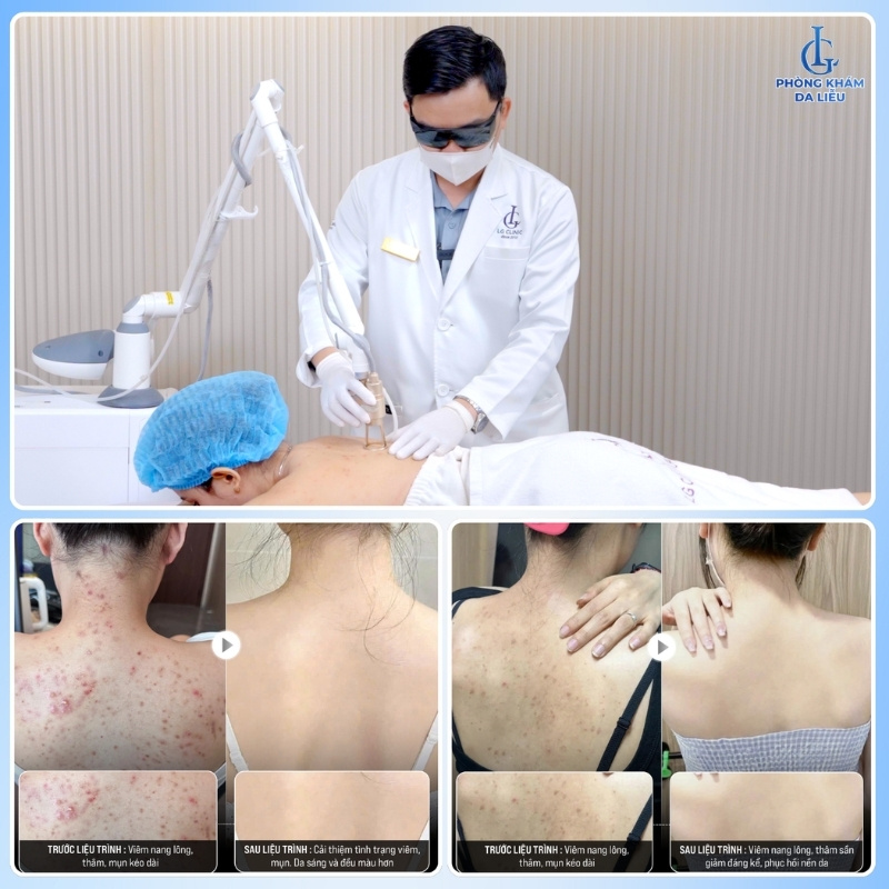trị viêm nang lông bằng acthyderm co2