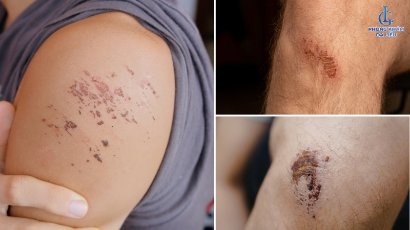 trường hợp có thể ăn tôm khi bị sẹo