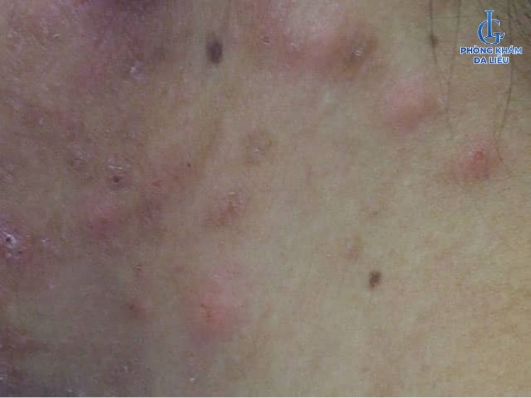 viêm nang lông tăng bạch cầu ái toan