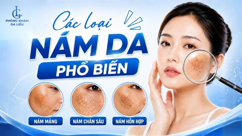 Các loại nám da phổ biến