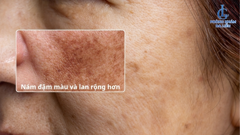 những yếu tố làm da bị nám