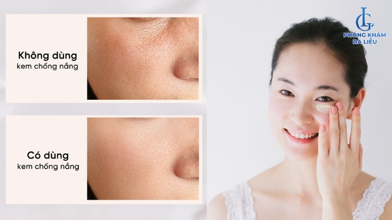 chống nắng khi điều trị nám da