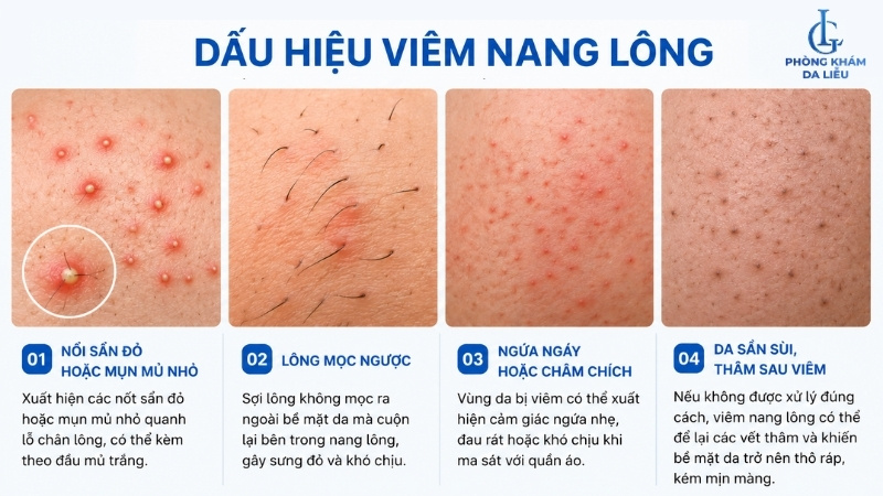 dấu hiệu nhận biết viêm nang lông