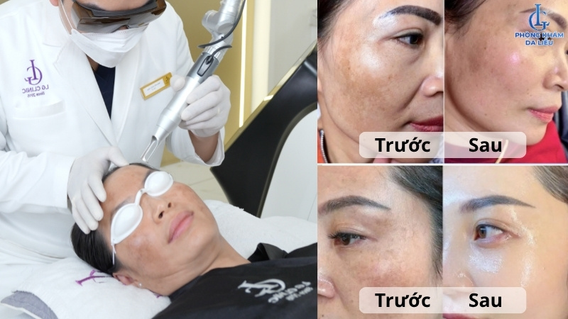 điều trị nám da công nghệ cao