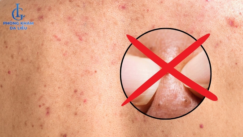 không tự ý cạy nặn trong quá trình trị mụn lưng