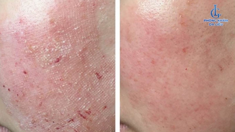 kiêng cử giúp giảm nguy cơ biến chứng sau khi trị nám bằng laser
