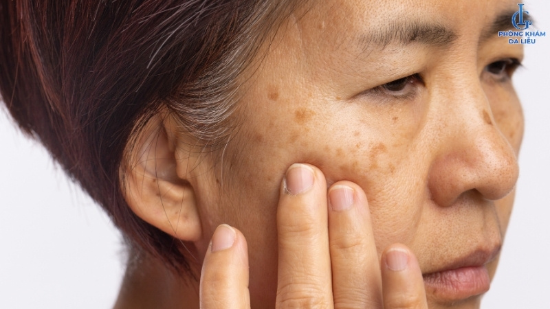 nám da có nhiều loại khác nhau