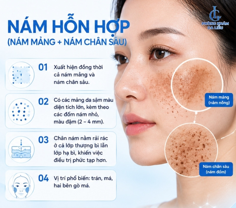 nám hỗn hợp