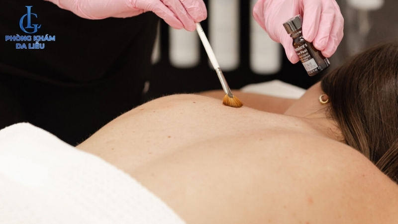 peel da trị mụn lưng