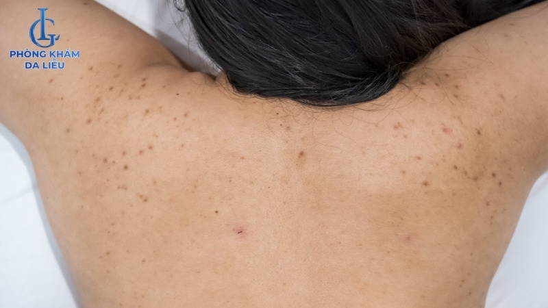trị mụn lưng tại nhà hiệu quả với mụn nhẹ và trung bình