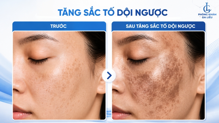 Tăng sắc tố dội ngược