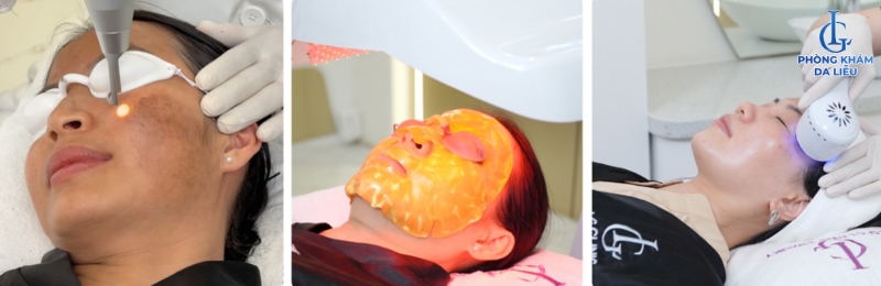trị nám bằng laser