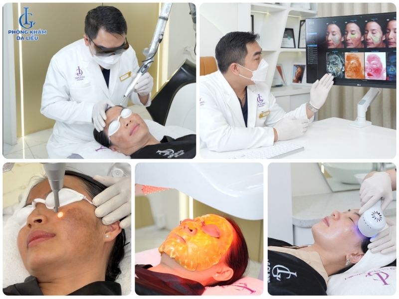 Trị nám tại Phòng khám Da liễu LG Clinic