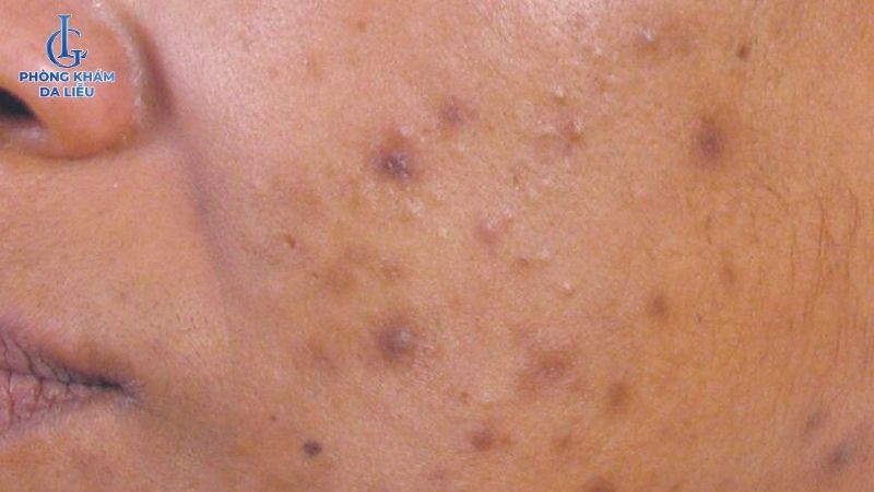 Nguyên nhân da mặt sạm đen do mụn