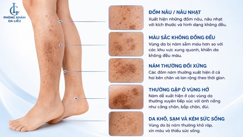 dấu hiệu nhận biết nám ở chân