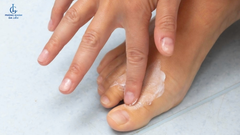 điều trị nám da chân bằng thuốc bôi
