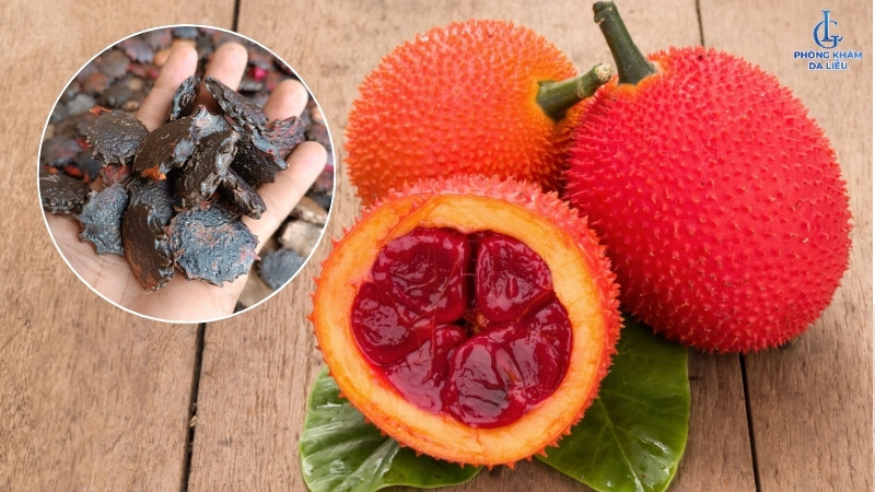 hạt gấc ngâm rượu trị nám