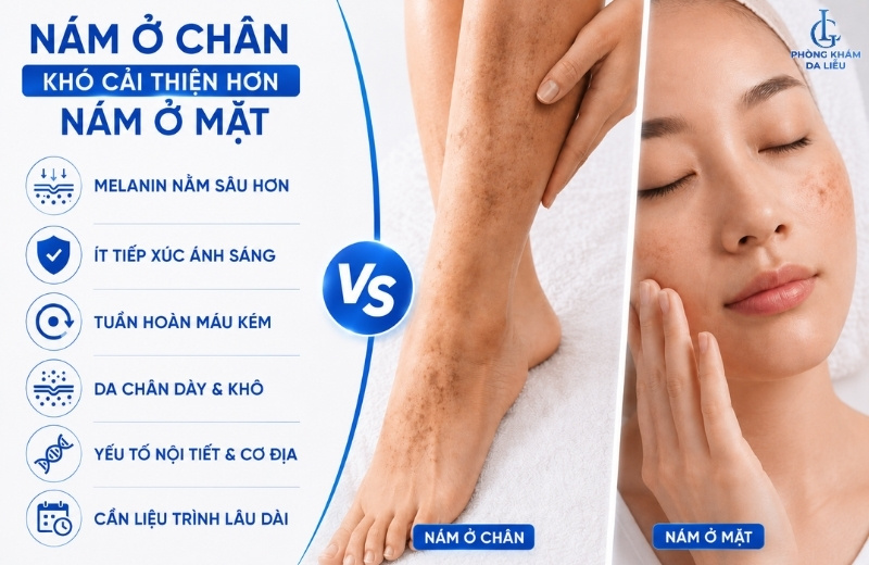 nám ở chân là gì