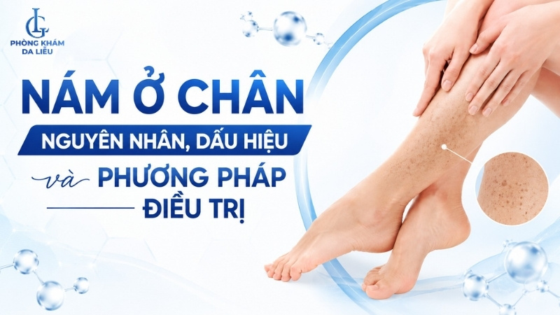 nám ở chân