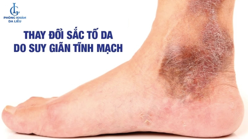 thay đổi sắc tố da do suy giảm tĩnh mạch