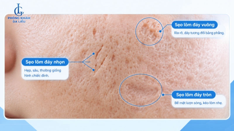 Các loại sẹo rỗ thường gặp