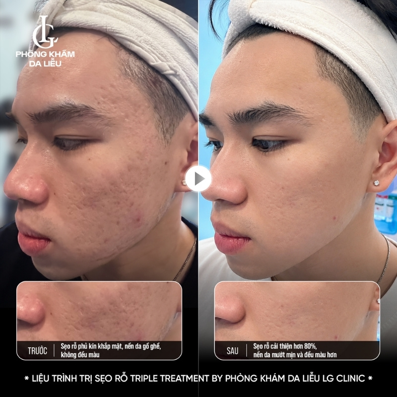 cách điều trị sẹo rỗ lâu năm