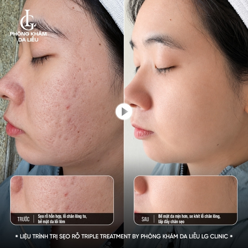 cách trị sẹo rỗ lâu năm
