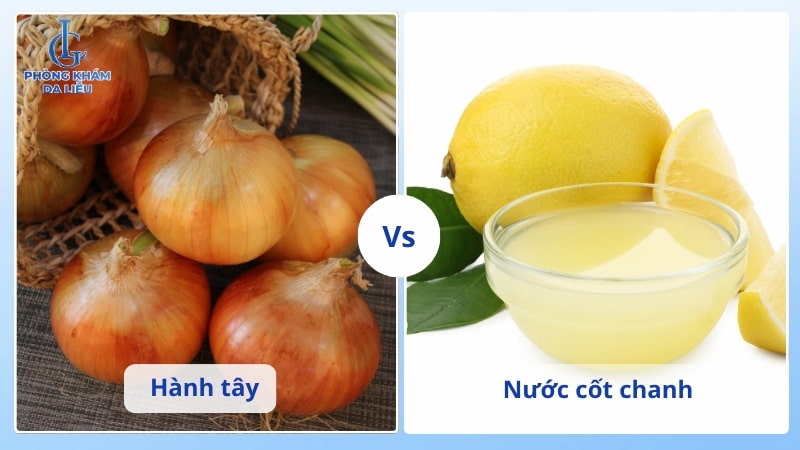 hành tây và chanh giúp trị sẹo lõm
